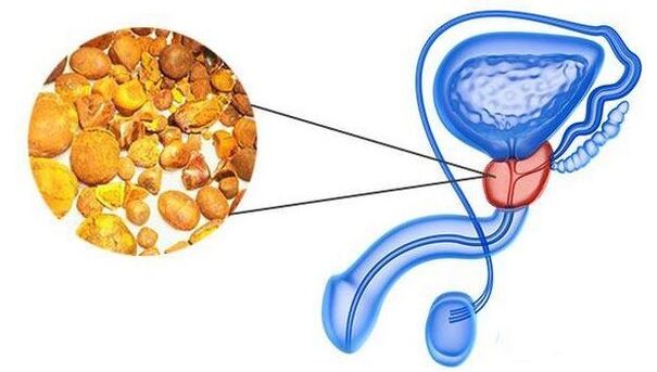 At calcinal in the prostate gland