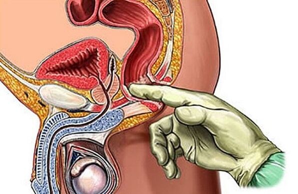 Prostate massage as one way of treating prostatitis