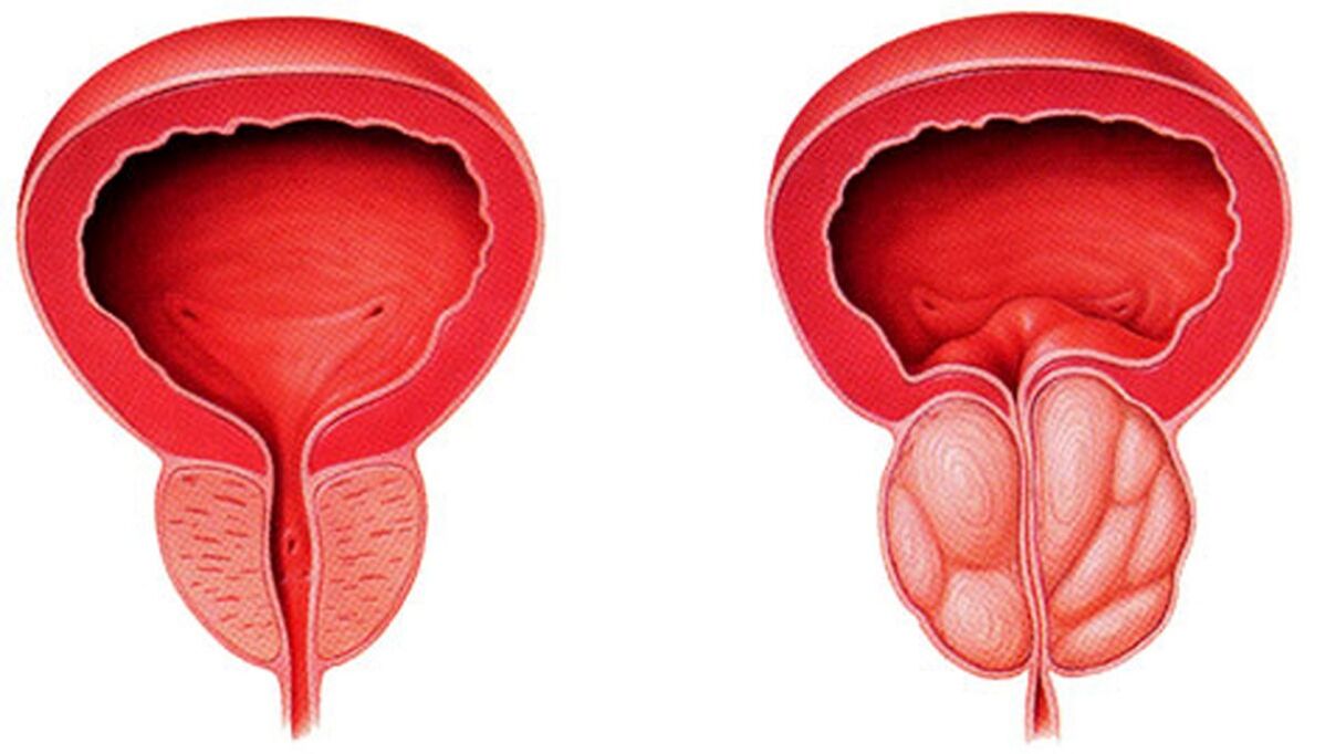 healthy and inflamed prostate with prostatitis