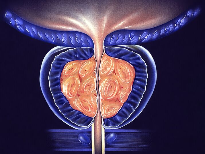 prevention of prostatitis and prostatitis