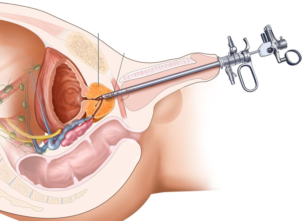 Transurethral resection of the prostate makes it possible to remove the affected parts of the organ