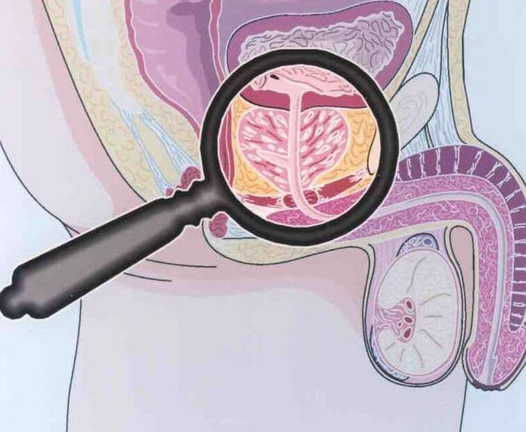 Defeat of prostate tissue in patients with chronic prostatitis