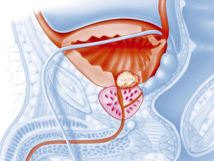 In case of chronic prostatitis, the lumen of the urethra narrows, which makes it difficult for urine to flow out. 